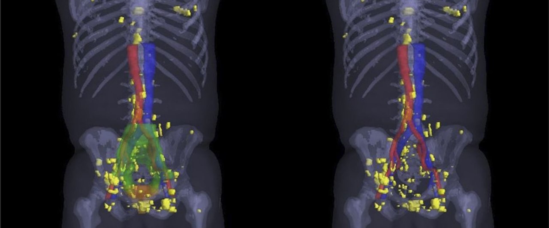 is-nuclear-medicine-safer-than-ct-scans